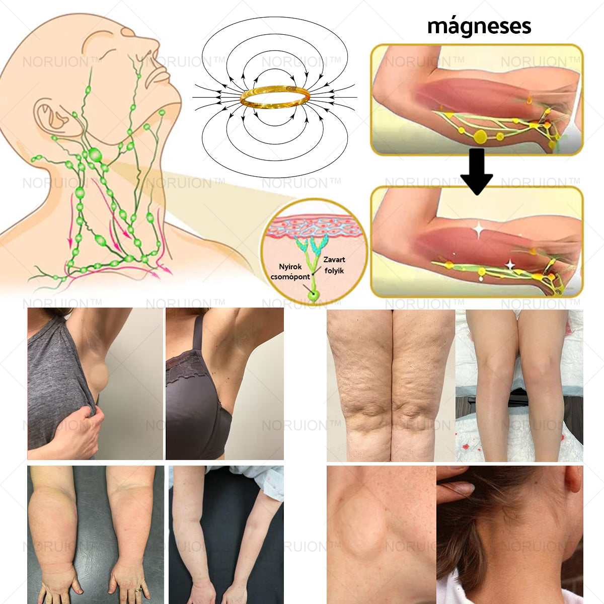 💥【BLACK FRIDAY AKCIÓ】80% KEDVEZMÉNY 🔥NORUION Lymphatikus Terápiás Magnetikus Gyűrű Macska Szemével